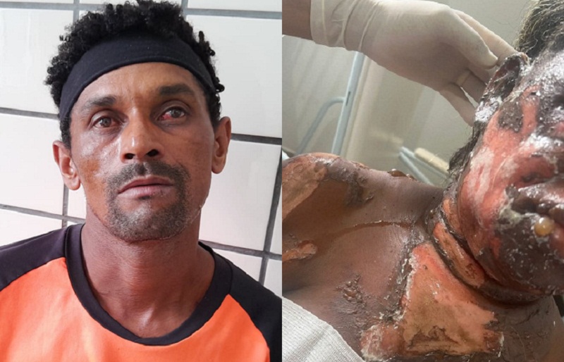 Homem é preso pela PM após atear fogo na esposa em Ibirapuã: Vítima está em estado grave